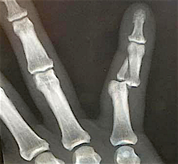 An x-ray showing the fracture